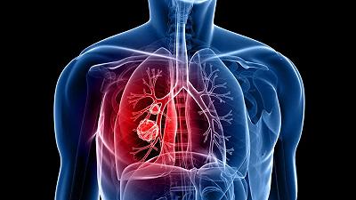El nuevo sistema para la terapia con cáncer de pulmón está inspirado en mejillones